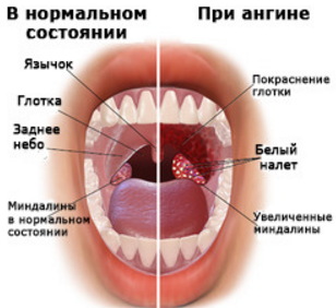 небные миндалины в нормальном состоянии и при ангине