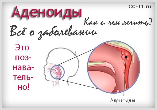 аденоиды - все о заболевании, как и чем лечить