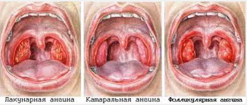Классификация детских ангин