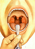 тонзиллит больные гланды