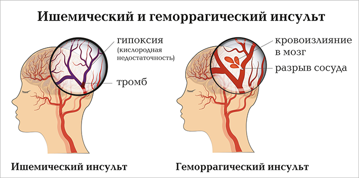 Геморрагический и ишемический инсульт