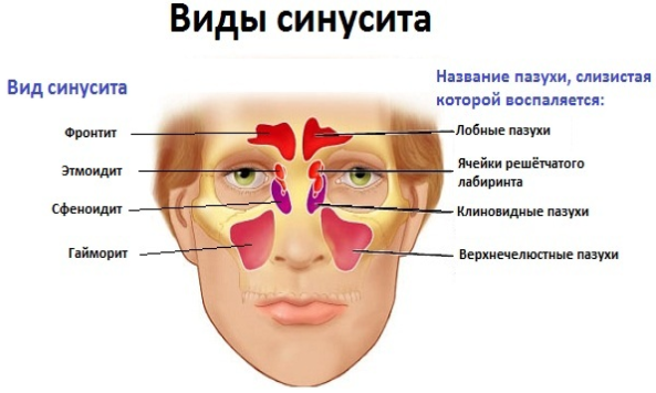 виды синусита