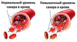 норма сахара в крови и повышенный уровень