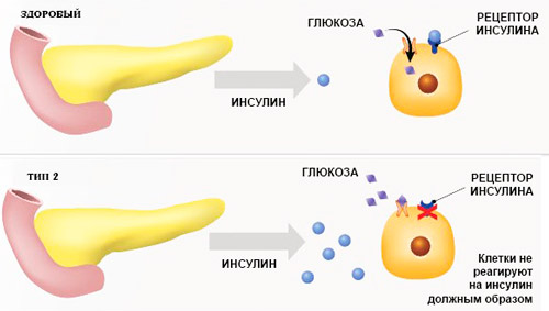 усвоение глюкозы здоровым организмом и при диабете 2 типа