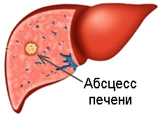 абсцесс печени