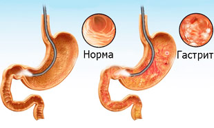воспаление слизистой оболочки при анацидном гастрите