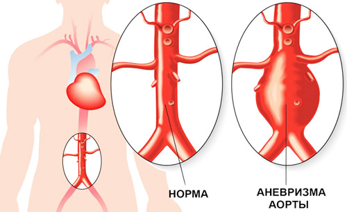 нормальная аорта и с аневризмой