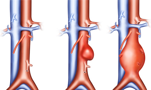здоровая аорта и разновидности аневризмы