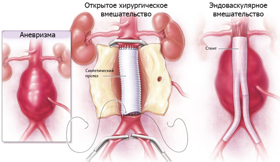 варианты лечения: хирургическое и эндоваскулярное вмешательство