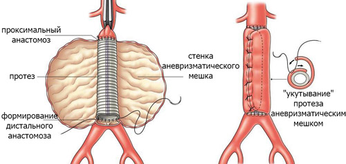 схематический рисунок проведения операции