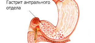 воспаление слизистой антрального отдела желудка