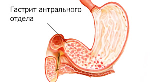 воспаление слизистой антрального отдела желудка