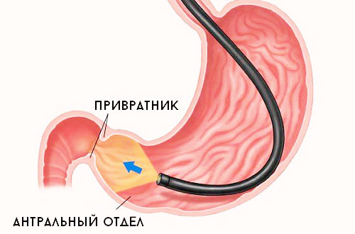 эндоскопия антральный отдела на предмет заболевания