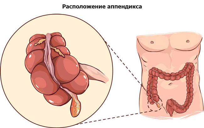 анатомическое расположение аппендикса