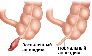 воспаленный и нормальный аппендикс