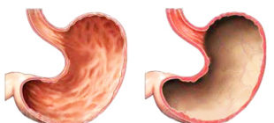 здоровый желудок и с гастритом