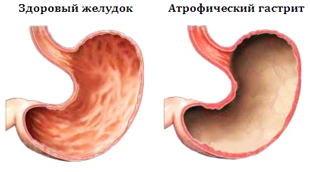 здоровый желудок и с гастритом