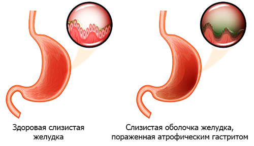 слизистая желудка в здоровом состоянии и пораженная атрофическим гастритом