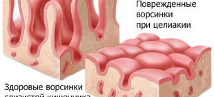 здоровые и поврежденные ворсинки кишечника при целиакии