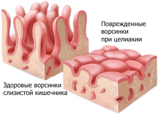 здоровые и поврежденные ворсинки кишечника при целиакии