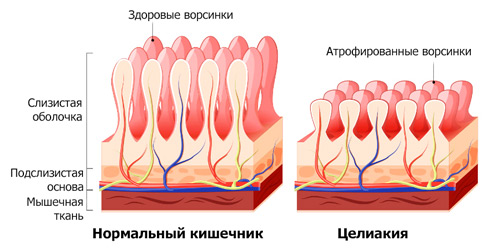 строение стенок здорового и больного кишечника