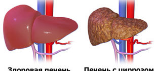 здоровая печень и с циррозом