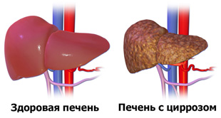 здоровая печень и с циррозом