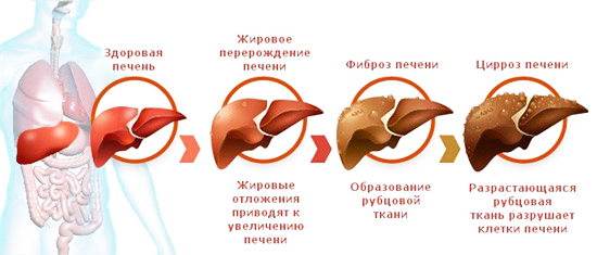 стадии развития цирроза печени