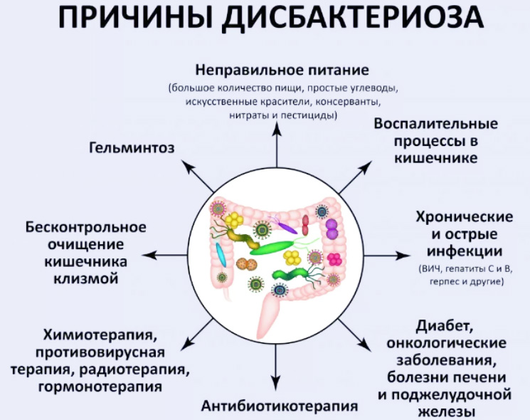 причины дисбактериоза кишечника схематично