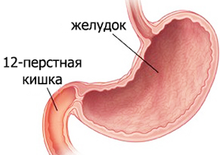 воспаление 12-перстной кишки