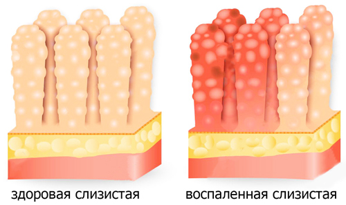 воспаление слизистого эпителия 12-перстной кишки