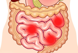 воспаление отделов кишечника