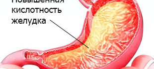 повышенная кислотнось в желудке причина гастрита