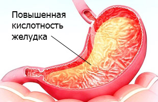 повышенная кислотнось в желудке причина гастрита