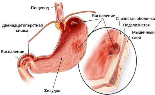 очаги воспаления желудка при гастродуодените