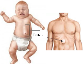 грыжа белой линии живота у ребенка и взрослого