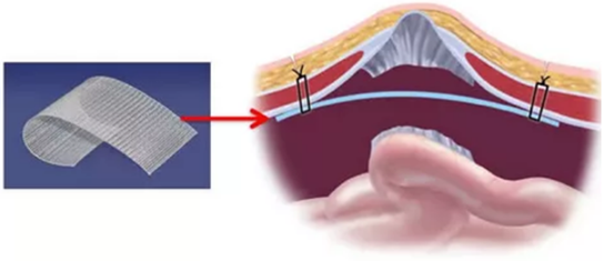 сетчатый протез для лечения грыжи брюшной стенки