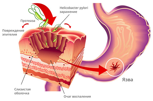 язва желудка вызванная бактериями