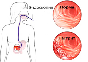 снимок здорового желудка и с гастритом