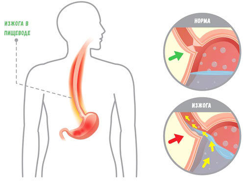схематический рисунок изжоги