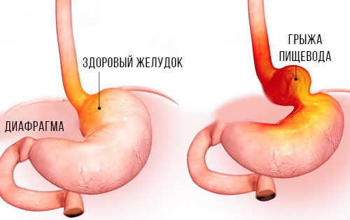 здоровый желудок и с грыжей пищевода