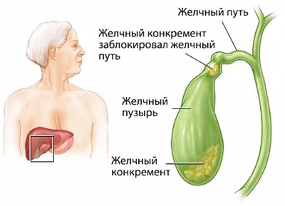 конкременты в желчном пузыре