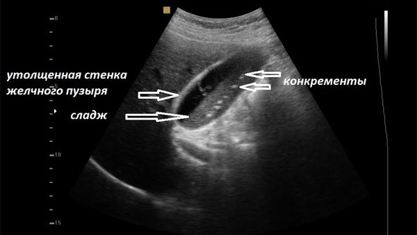 Диагностика калькулезного холецистита с помощью УЗИ