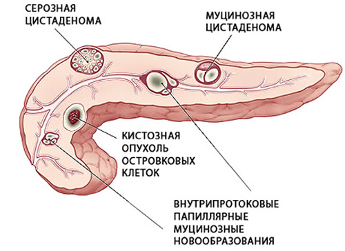 виды образований в поджелудочной