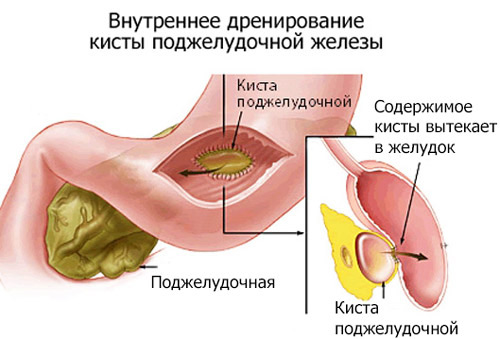 лечение с помощью дренажа кисты