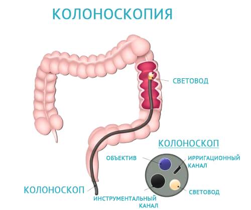 колоноскопия - основной инструментальный метод диагностики колита