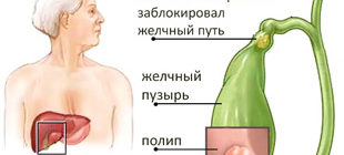 рисунок полипа в желчном пузыре