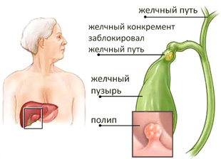 схематический рисунок полипа в желчном пузыре