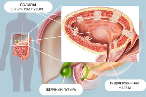 анатомия тела и разрастание полипов