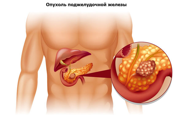 опухоль поджелудочной железы как причина пупочной боли